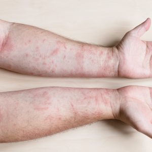 Novedades sobre la viruela símica